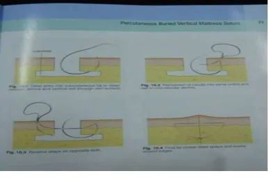 Gambar 1: teknik jahitan percutaneous 