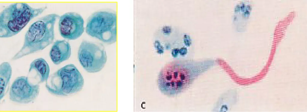 Gambar 1. Gambaran sitologi karsinoma sel skuamosa