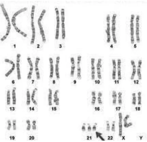 Gambar 2.1. Kelainan kromosom trisomi 21 (Situmorang, 2011). 