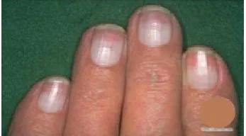 Gambar 2.4. absen lunula  