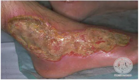 Gambar 2.9 : Pyoderma Gangrenosum 