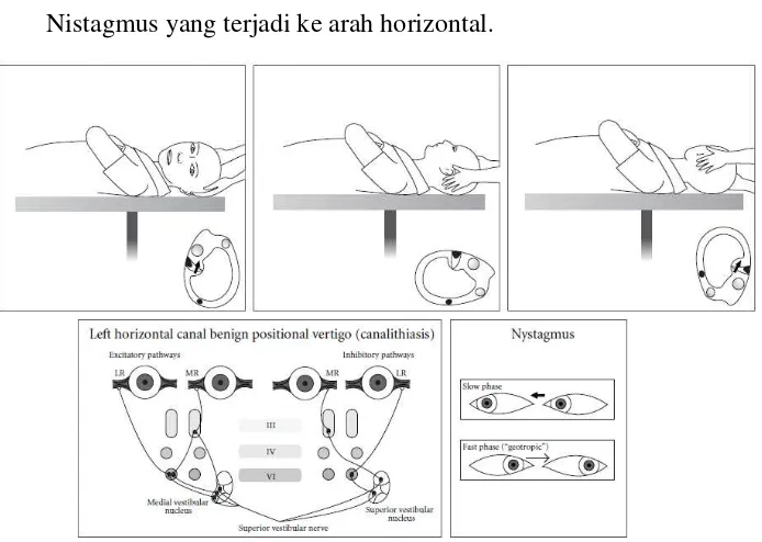 Gambar 2.7 Pola nistagmus pada kanalis semisirkularis anterior telinga kiri (Hornibrook, 2011) 