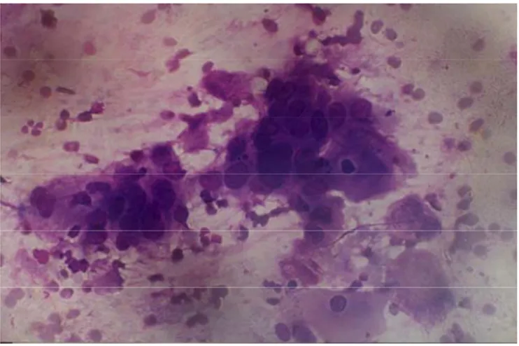 Gambar 4.  Squamous cell carcinoma, inti polimorfis,   khromatin kasar, batas sel jelas, sitoplasma  kebiruan (Dikutip dari: Lubis M