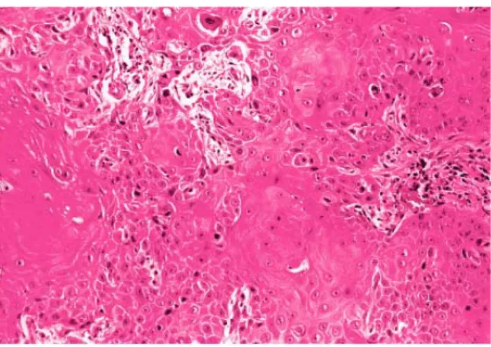 Gambar 6. Keratinizing Squamous Cell Carcinoma  (Dikutip dari: Rosai J. Rosai and  Ackermans Surgical Pathology,Volume one, Ninth Edition, Philadelphia: Mosby, 
