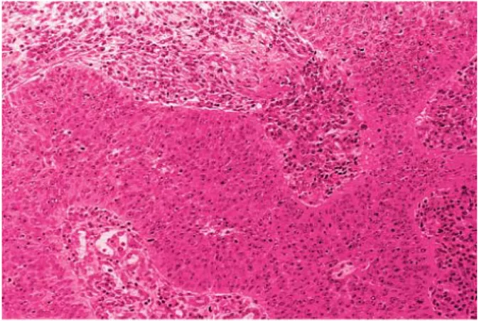 Gambar 7. Non Keratinizing Squamous Cell Carcinoma. (Dikutip dari: Rosai J. Rosai  and Ackermans Surgical Pathology,Volume one, Ninth Edition, Philadelphia: Mosby, 