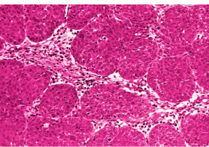 Gambar 9. Undifferentiated  Carcinoma terdiri dari sel-selyang membentuk sarang-sarang padat            ( “Regaud type”)