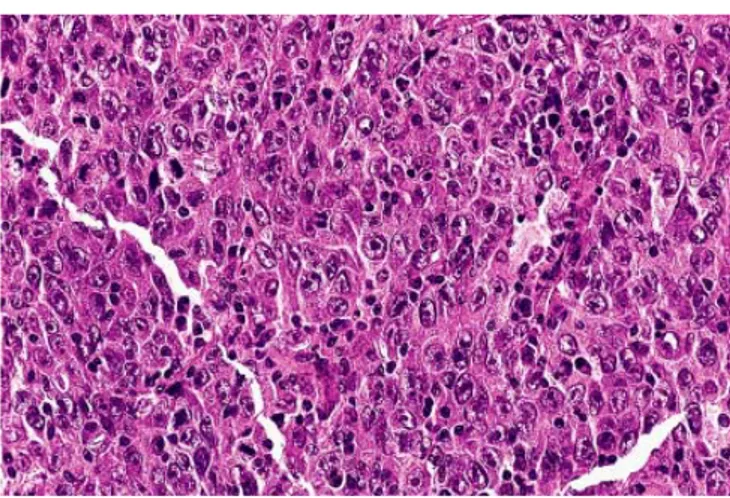 Gambar 10.Undifferentiated Carcinoma terdiri sel-sel yang tumbuh membentuk gambaran  syncytial yang difus   (Schmincke type)
