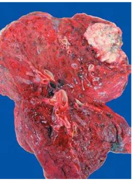 Gambar 2.7 Gambar sitologi adenocarcinoma paru. Sel saling tumpang tindih dengan sitoplasma yang sedikit dan pucat, inti sel relatif besar