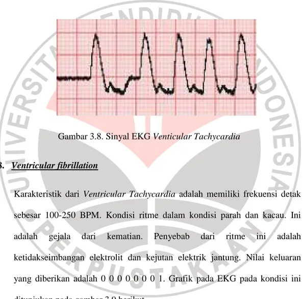 Gambar 3.8. Sinyal EKG Venticular Tachycardia 