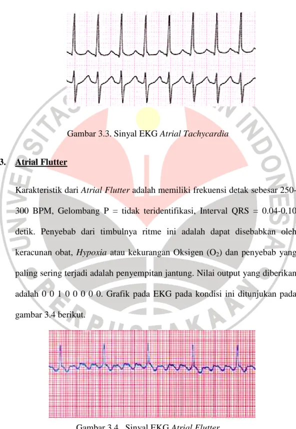 Gambar 3.3. Sinyal EKG Atrial Tachycardia 
