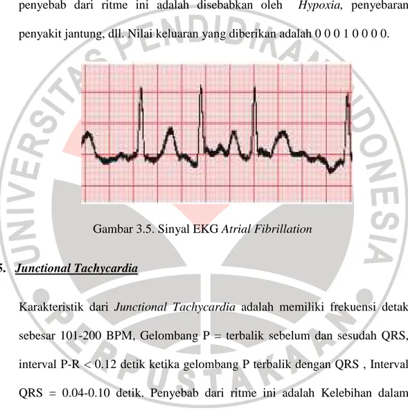 Grafik pada EKG pada kondisi ini ditunjukan pada gambar 3.5. Karakteristik  Atrial  Fibrillation  adalah  memiliki  frekuensi  detak  jantung  sebesar  400-700  BPM, Gelombang P = tidak teridentifikasi dan tidak berurutan secara teraur