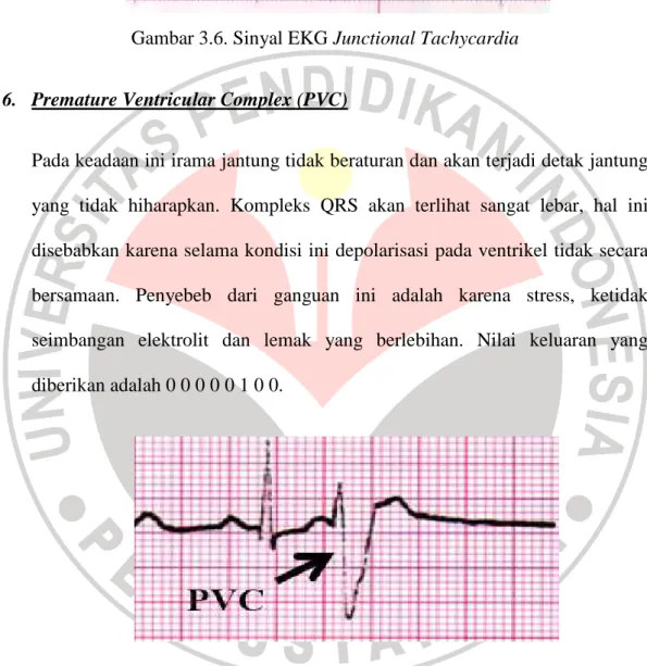 Gambar 3.7. Sinyal EKG Premature Ventricular Complex (PVC) 