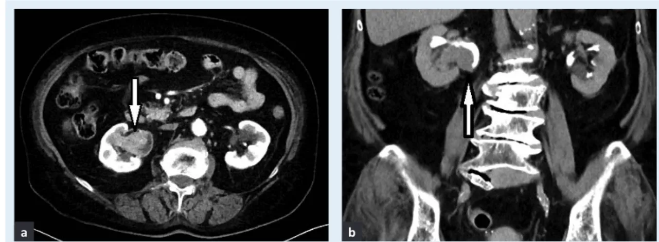 Figure 1 Transitional cell carcinoma of the pelvicalyceal system of the right kidney shown in a) nephrographic and  b) excretory phase