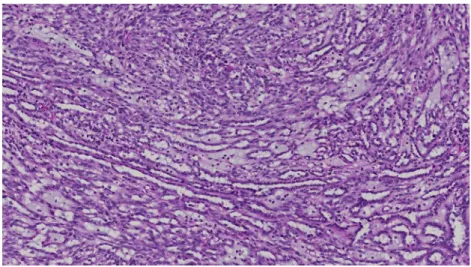 Fig. 1 Mucinous tubular and spindle-cell carcinoma showing classical pattern with elongated tubules, spindle-cell areas, and stromal mucin