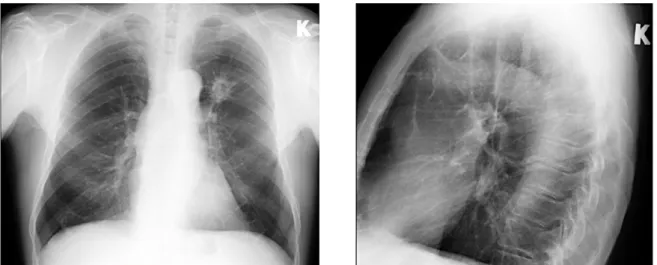 Figure 1. Chest x-ray is showing solid mass in left lung S1-2