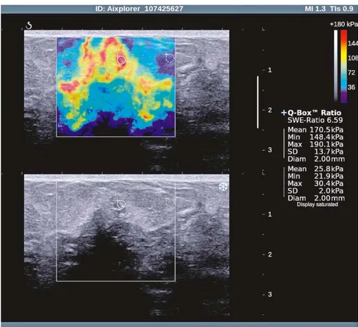Fig. 4. Ductal in situ carcinoma – sonoelastographic and gray-scale ultrasound image.