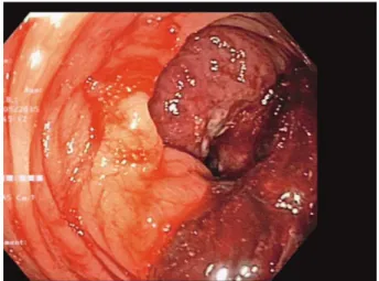 Fig. 1. Colonoscopy view of the tumor in the hepatic  flexure.