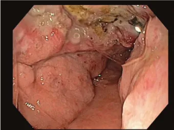 Fig. 4. Tumorous formation in the stomach as displayed  on EGDS.