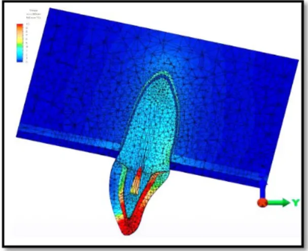 Gambar 2.10  Sebuah Model Finite Elemen Analisis Tiga Dimensi Perawatan Gigi Endodonti  Insisivus Sentralis Atas dengan Jaringan Pendukungnya (Adıgüzel dkk, 2011)    