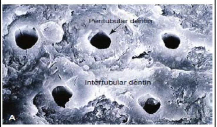 Gambar 2.2 Tubulus Dentin dengan Menunjukkan  Peritubular dan Intertubular  Dentin  (Marshall dkk, 1999 dalam buku Craig’s Restorative Dental Material)  