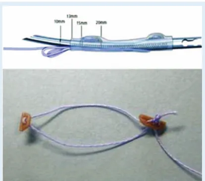 Figure 19. The all-inside meniscus suture technique with the Omni span system. Placing of two 5 mm anchors