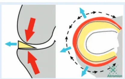 Figure 3. Contact surface reduction and load increase on the place of  contact between two condyles after meniscectomy