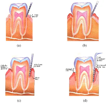 Gambar 1. Tahapan penyakit periodontal : (a) batas gingiva normal           