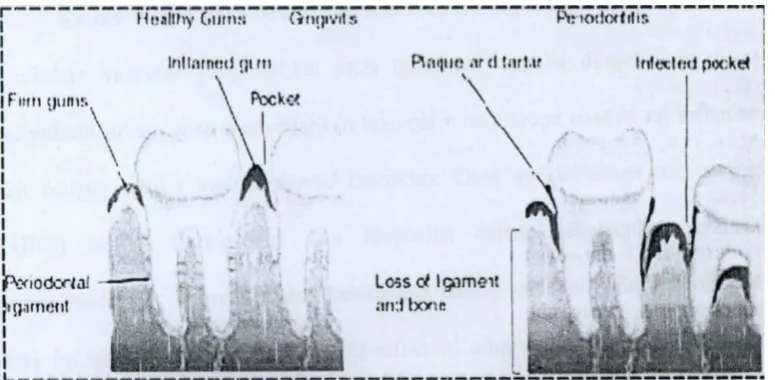 Gambar 6. Perbedaan antara gingival sehat, gingivitis dan periodontitis 