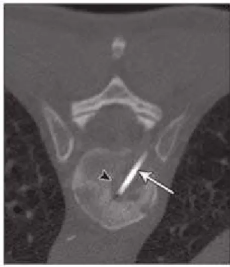 Gambar aksial tulang menunjukkan inti jarum biopsi (panah)  melalui tulang belakang lesi litik (panah) menggunakan pendekatan  transpedikular