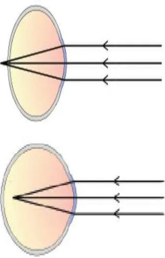 Gambar 1 Pembiasan cahaya pada mata normal dan mata dengan kelainan                                                                              