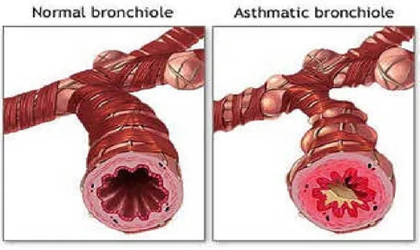 Gambar 2.1. Anatomi keadaan normal dan asmathic pada bronkial ( sumber : Syaifuddin, 2009 )
