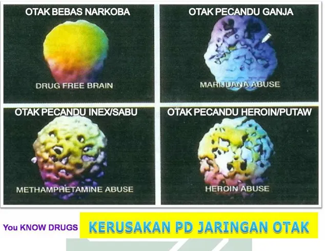 Gambar 4.2 Kerusakan pada Jaringan Otak Akibat Narkotika  Sumber: BNN Provinsi Jambi, Kerusakan Otak Akibat Penyalahgunaan  Narkoba, (online), 
