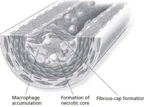 Gambar 4: Pembentukan lesi aterosklerotik yang semakin kompleks