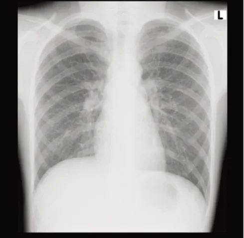 Figure 1. Initial chest x-ray shows diffuse interstitial nodular lesions