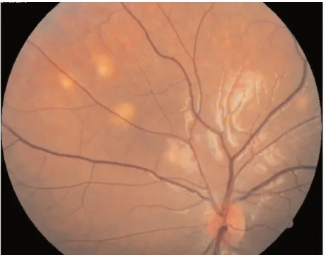 Figure 3. Initial funduscopic examination reveals disseminated chorioretinitis of both eyes Slika 3