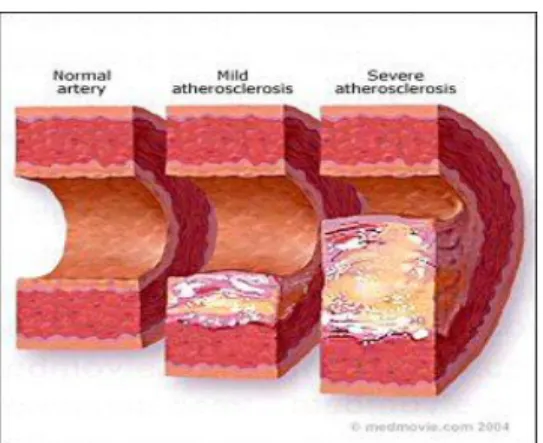 Gambar 2.3 Aterosklerosis  (Dikutip dari: Deddy 2009). 