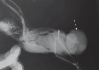 Fig. 1. On lateral (LL) x-ray image (arrow marks xanthoma)