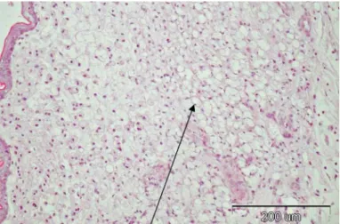 Fig. 4. Xanthoma histology. Aggregation of cholesterol in vacuoles. 