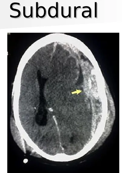 Gambar CT-Scan Hematoma 