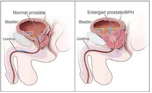 Gambar 2.3  Gambaran Prostat Normal Dibandingkan dengan BPH 