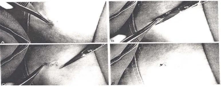 Gambar 2 a.Tarik dengan lembut dengan forsep untuk melihat dasar dari lesi dan untuk menunjukkan daerah yang dilakukan pengguntingan