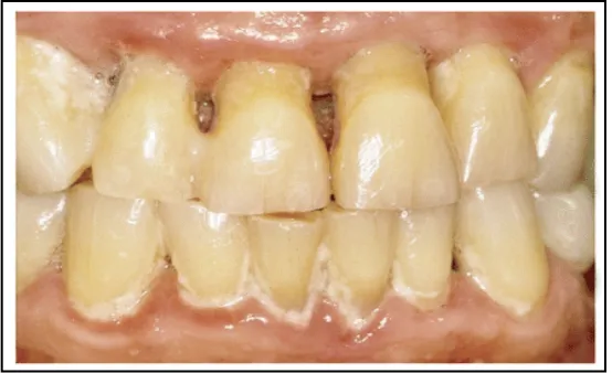 Gambar 7.Kondisi periodontal seorang pria 45 tahun  dengan penyakit jantung koroner.22 