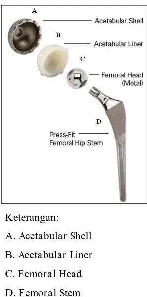 Gambar 2.7.  Artificial hip joint [5]. 