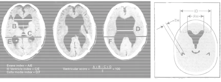 Gambar 1. Kriteria radiologis untuk meDikutip dari: Le May M, Hochberg FH.Venby CT. Neuroradiology 1979;17(4);191-195menilai hidrosefalus berdasarkan potongan aksial CT scan kepentricular differences between hydrostatic hydrocephalus an195  kepala