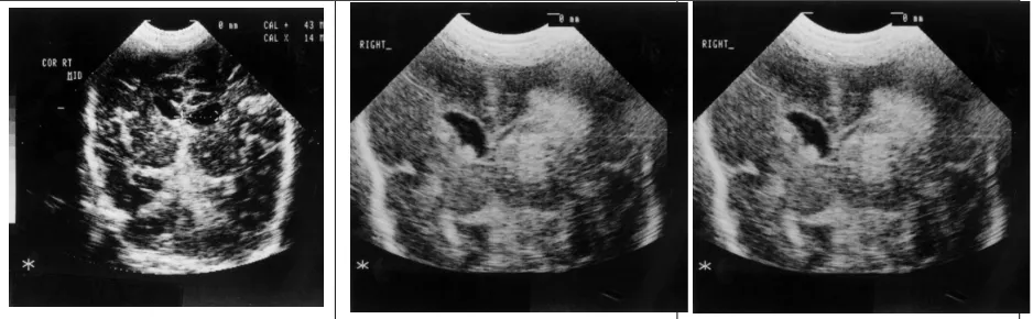 Gambar 2. Dari kiri ke kanan: Coronal ultrasound scan demonstrating an intermediate grade 1/ grade 2, grade 3, and  grade 4 