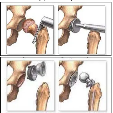 Gambar 2.4. Pemotongan tulang femur dan pemasangan hip joint prosthesis [33].