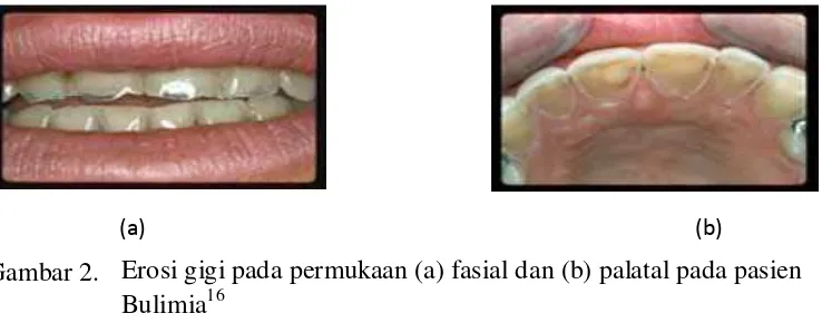 Gambar 2.  Erosi gigi pada permukaan (a) fasial dan (b) palatal pada pasien Bulimia16 