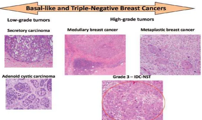 Gambar 2.1 Triple-negative breast cancer: Range of histology 