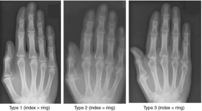 Gambar 2.9 Klasifikasi jenis tangan berdasarkan radiograf (Robertson  et al., 2008). 