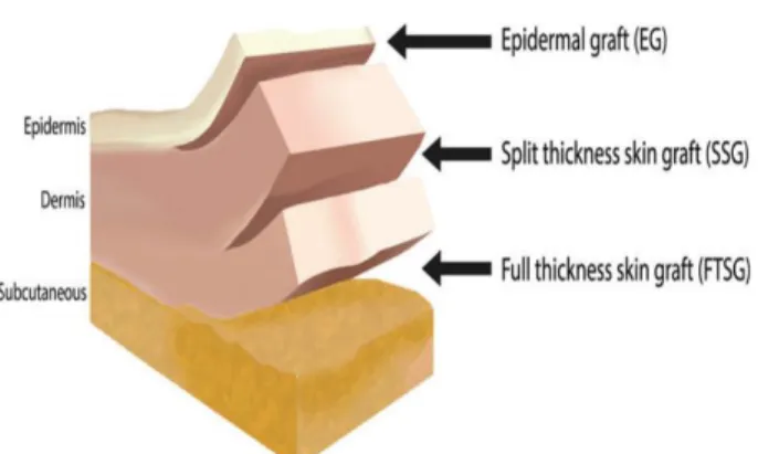 Gambar 1. Klasifikasi graft berdasarkan ketebalan lapisan kulit. 6 